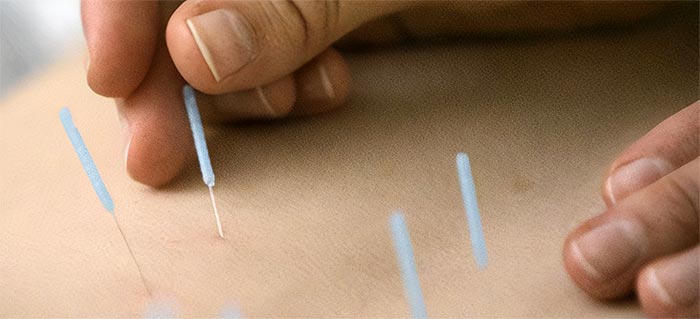 Das Schröpfen mit Nadeln ist eine Kombination aus Schröpftherapie und Akupunktur.
